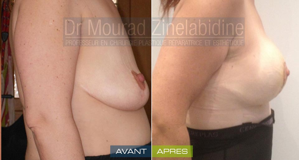 Photo avant & après lifting des seins (avec prothèses)