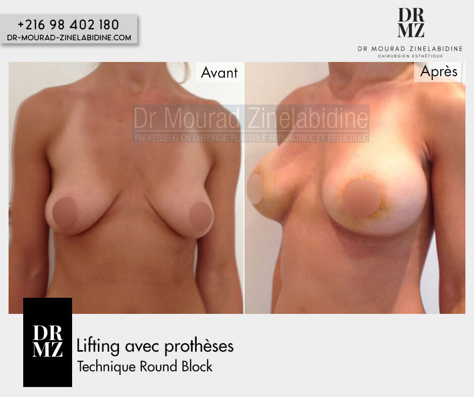Photo avant & après lifting des seins (avec prothèses:Round block)