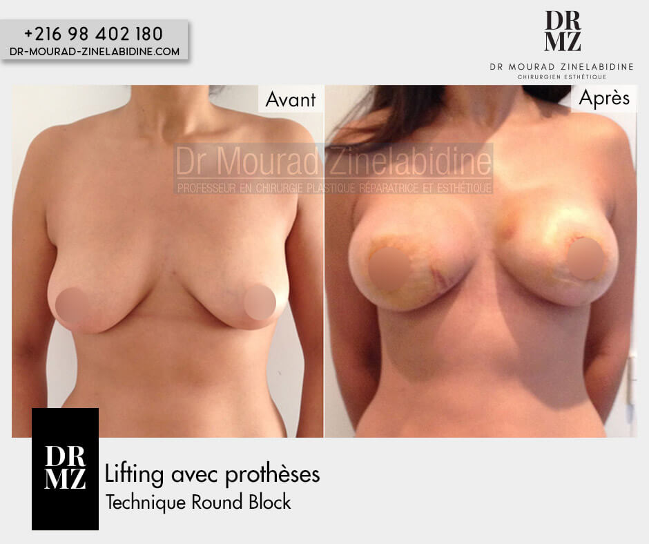 Photo avant & après lifting des seins (avec prothèses:Round block)