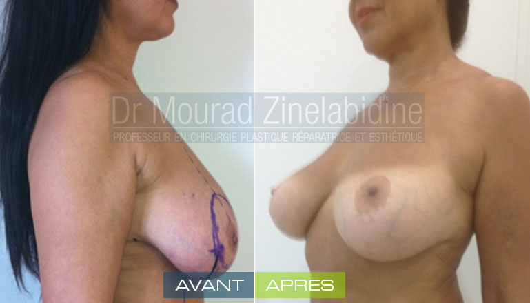 Photo avant & après lifting des seins (sans prothèses)
