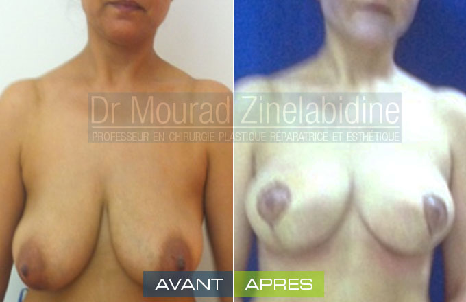 Photo avant & après lifting des seins (sans prothèses)