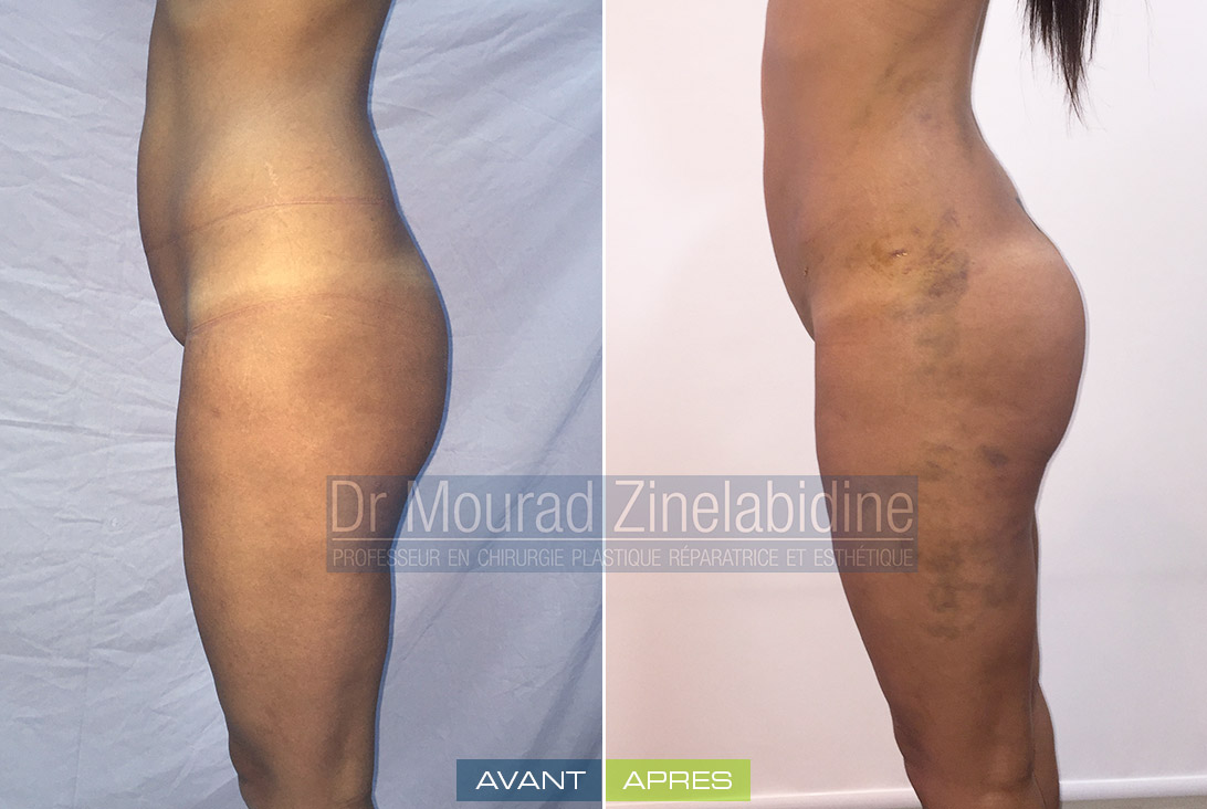Photo avant & après lipofilling des fesses (sans prothèses)
