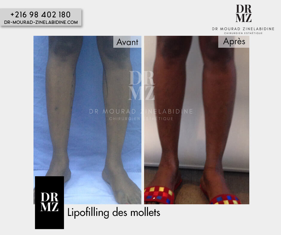 calf augmentation fat transfer Tunisia