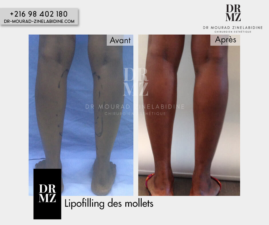 calf augmentation fat transfer Tunisia