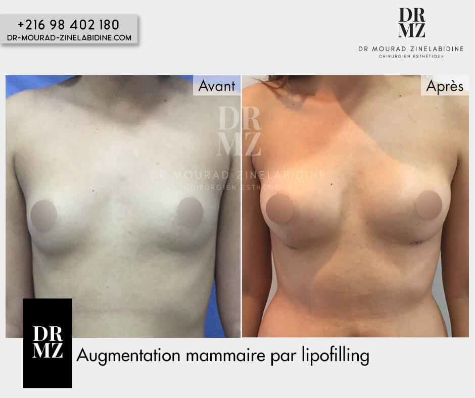 Photo avant & après lipofilling des seins