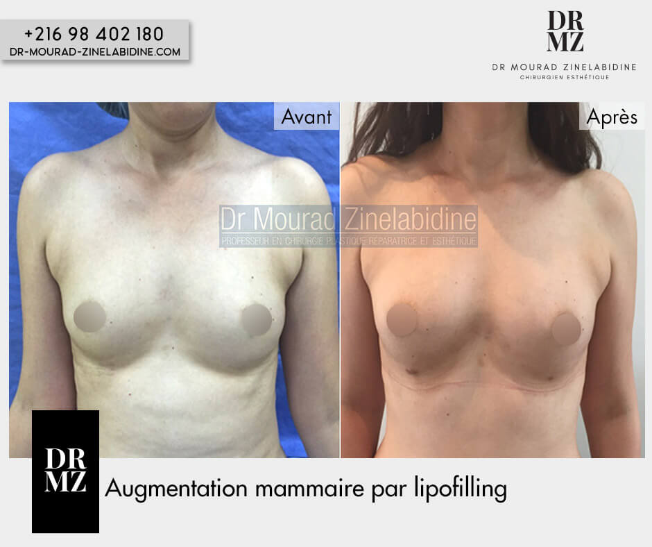 Photo avant & après lipofilling des seins