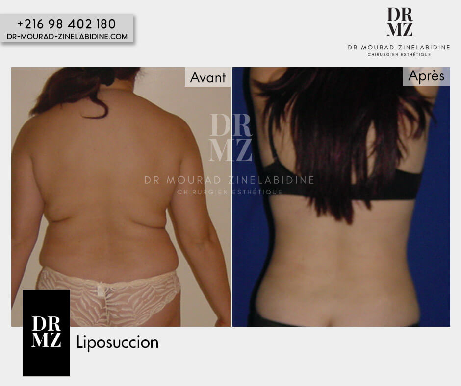 Photo avant & après liposuccion