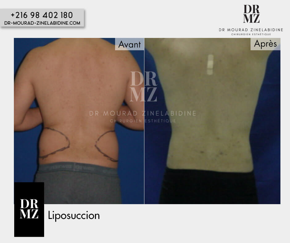 Photo avant & après liposuccion