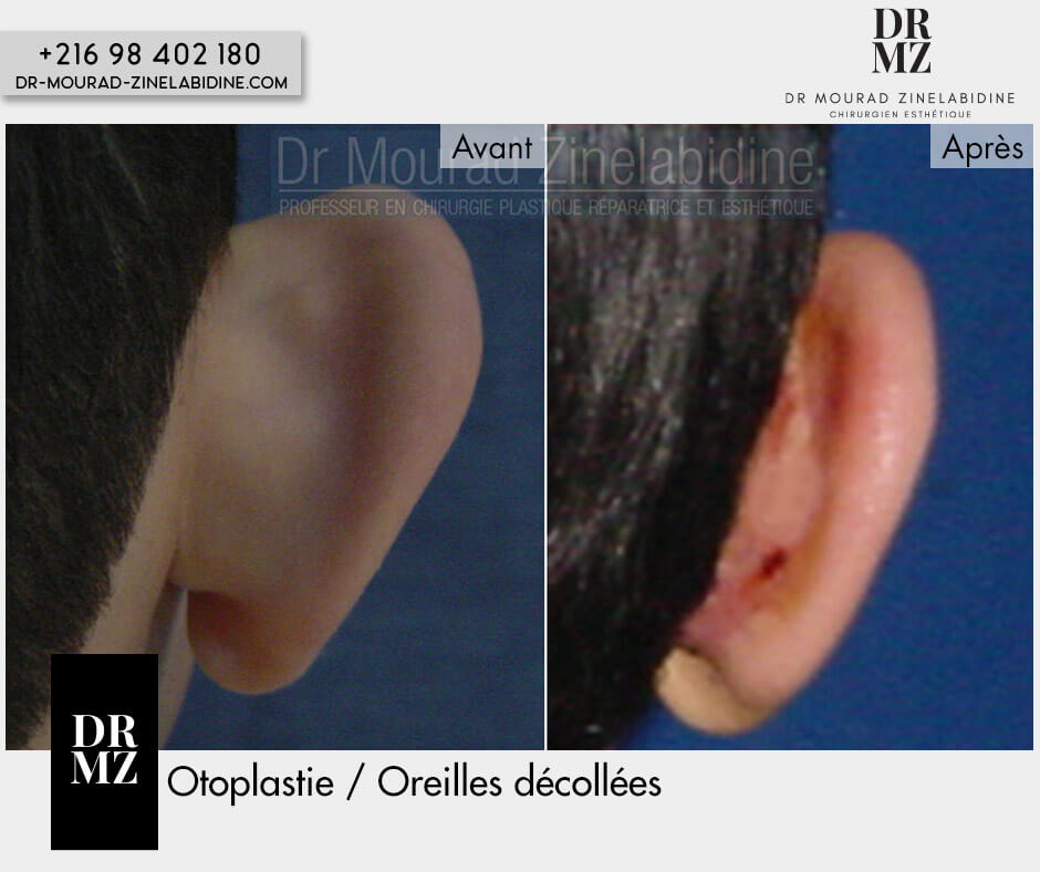 Otoplasty Tunisia