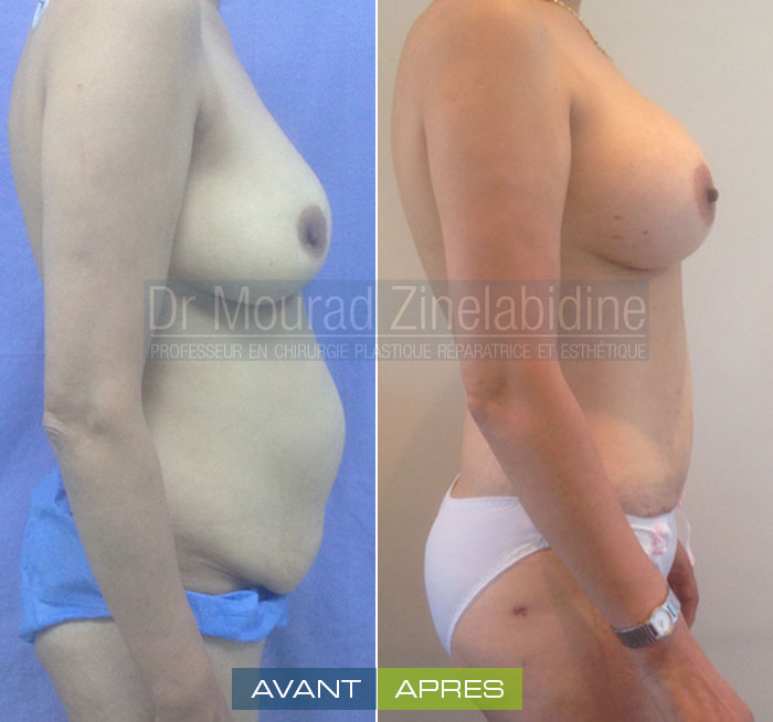 Photo avant & après abdominoplastie