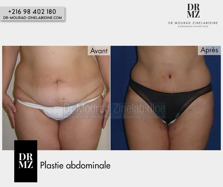 Photo avant & après abdominoplastie