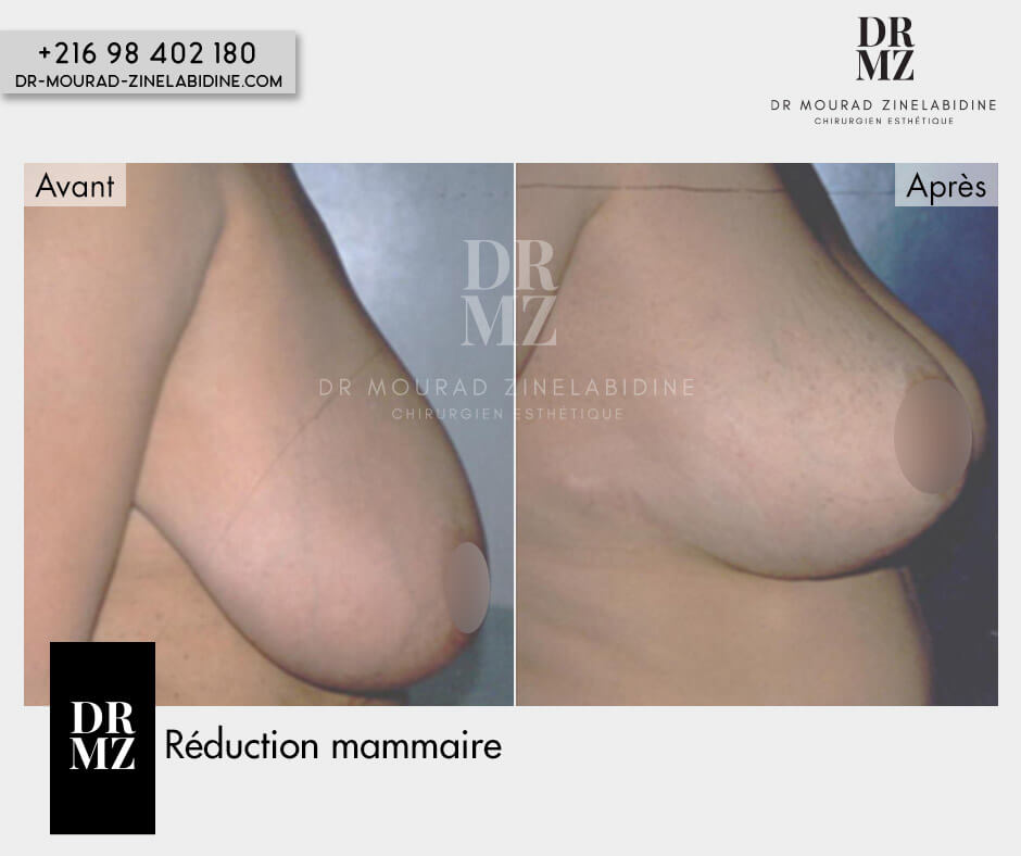 Photo avant & après réduction mammaire