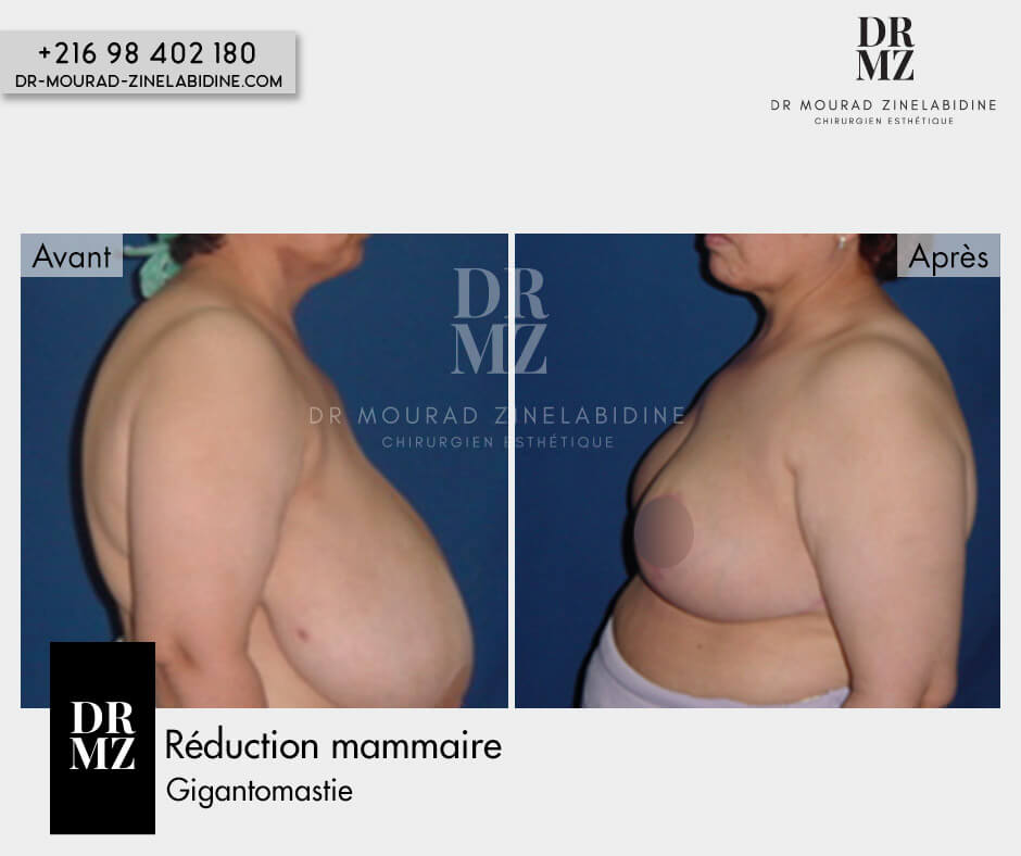 Photo avant & après réduction mammaire