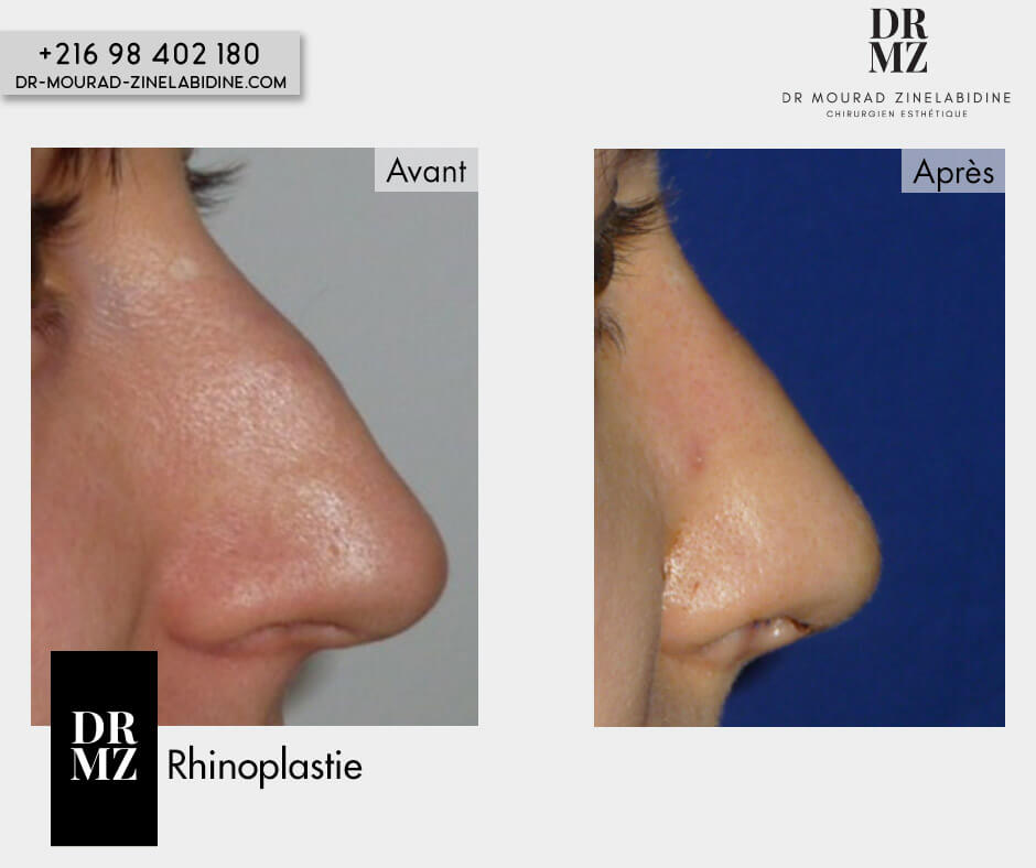 Photo avant & après rhinoplastie