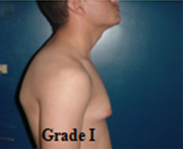 Gynecomastia Tunisia grade 1