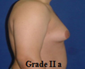 Gynecomastia Tunisia grade 2a