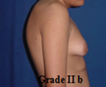 Gynecomastia Tunisia grade 2b