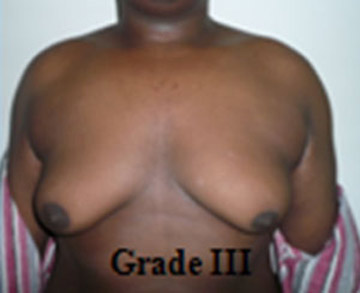 Gynecomastia Tunisia grade 3