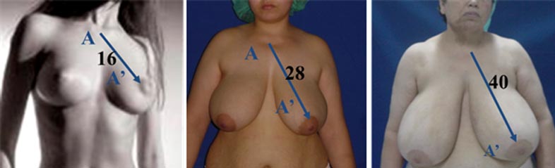 breast Uplift Tunisia