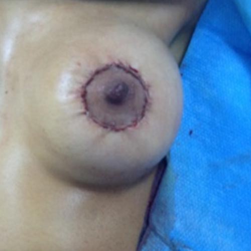 Roundblock breast lift Tunisia