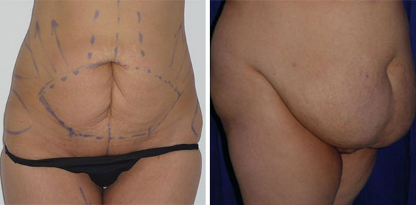 Abdominoplasty Tunisia : Tummy tuck strengthen stomach