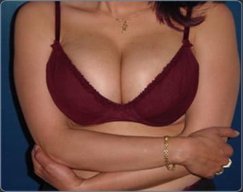 Breast reduction surgery