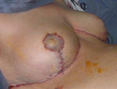 Breast reduction Tunisia