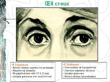 blepharoplastie Tunisie