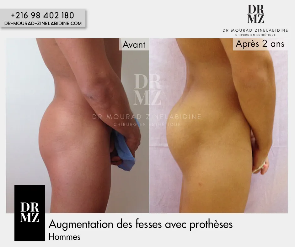 Photo avant & après augmentation fesses Tunisie