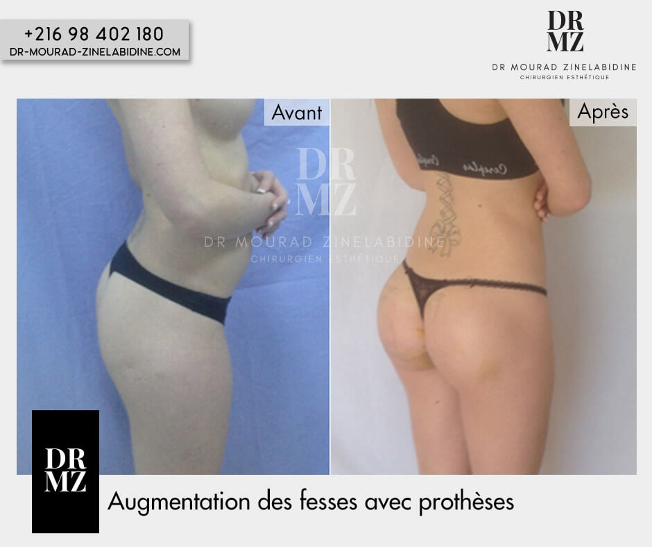 Augmentation fesses Tunisie