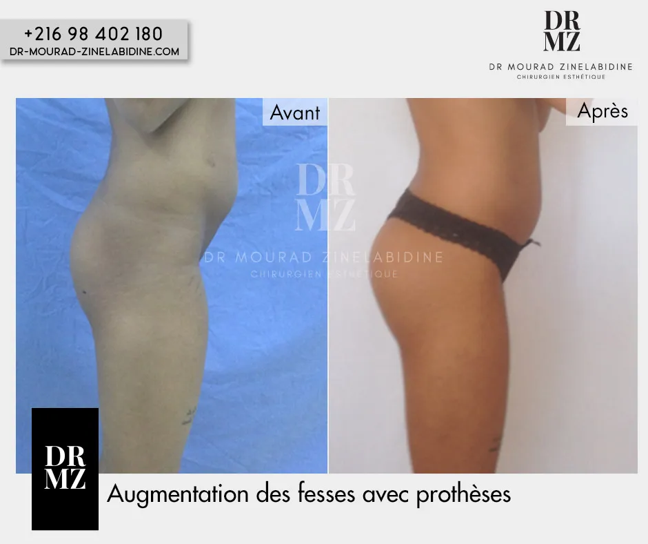 Photo avant & après augmentation fesses Tunisie