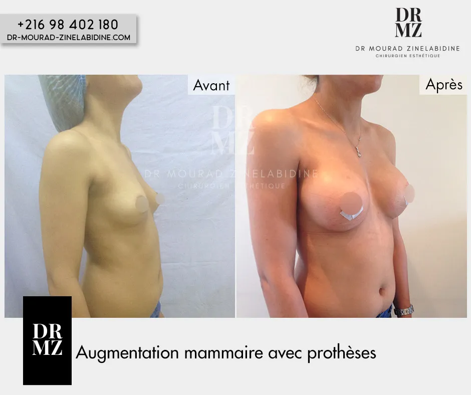 Photo avant & après augmentation mammaire Tunisie