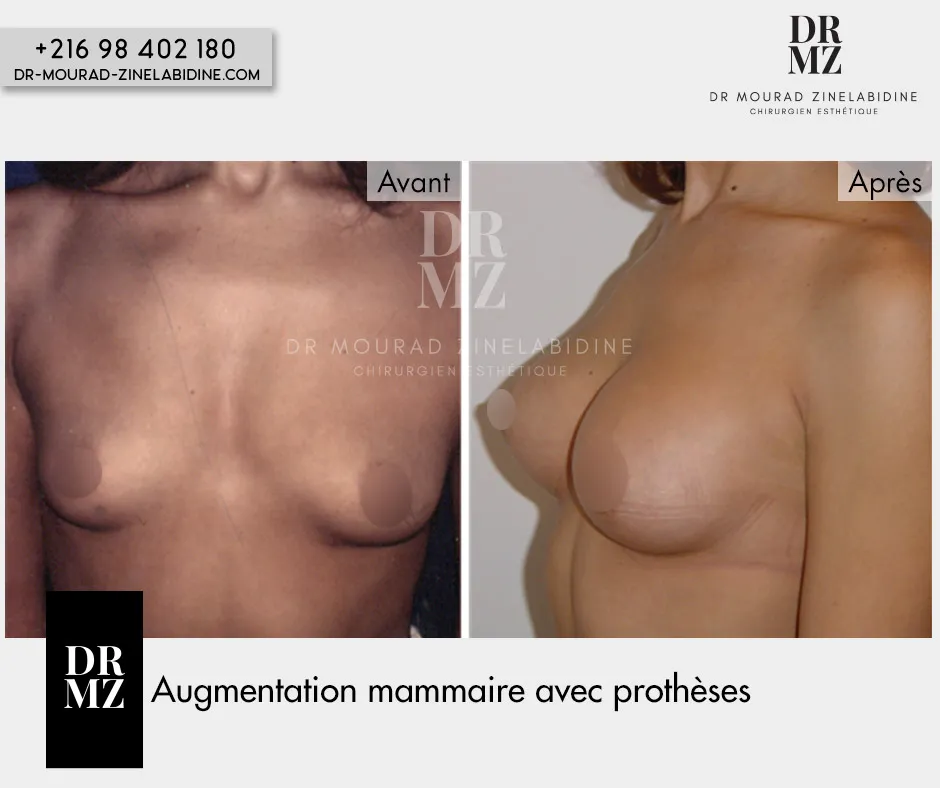 Photo avant & après augmentation mammaire Tunisie