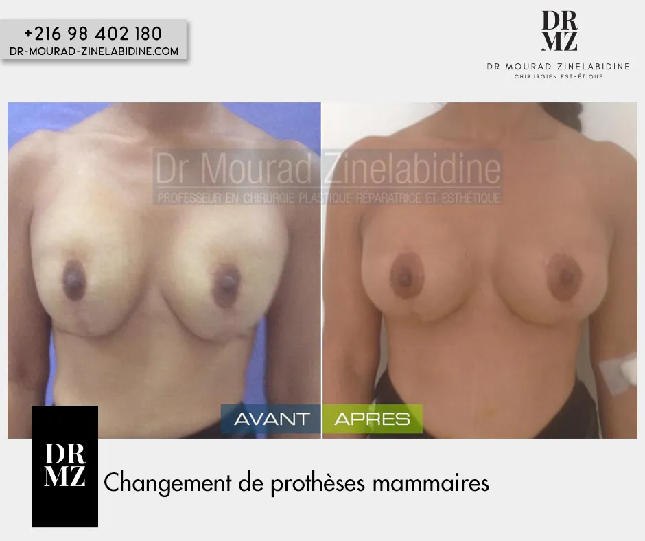 Changement de prothèses mammaires Tunisie