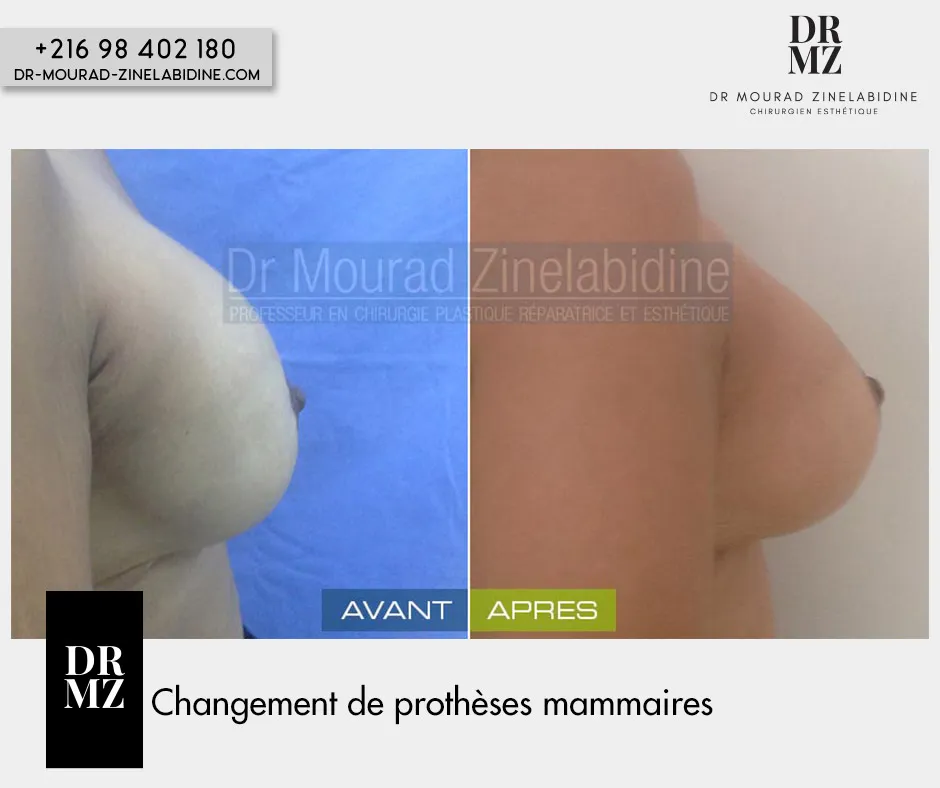 Changement de prothèses mammaires Tunisie