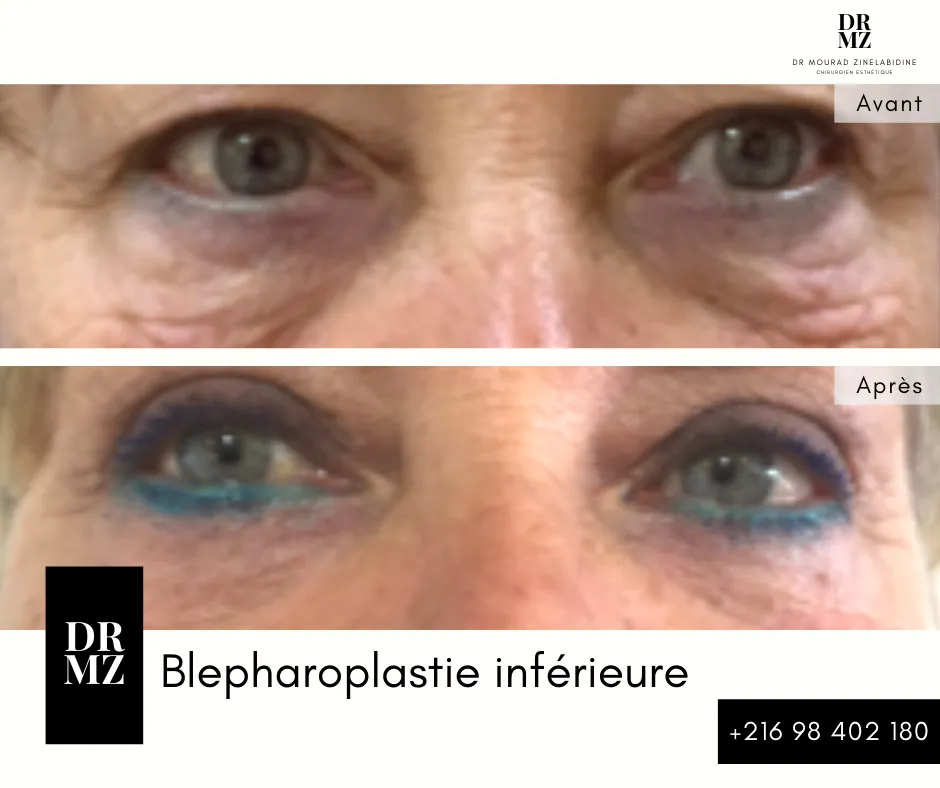 Photo avant & après blépharoplastie Tunisie