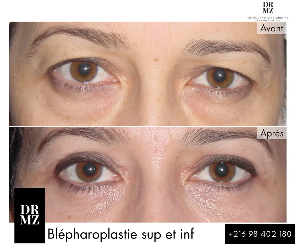 Photo avant & après blépharoplastie Tunisie