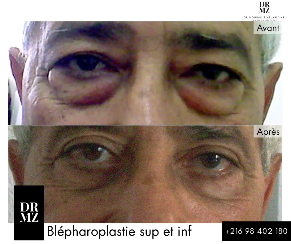 Photo avant & après blépharoplastie Tunisie