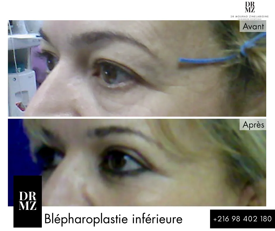 Photo avant & après blépharoplastie Tunisie