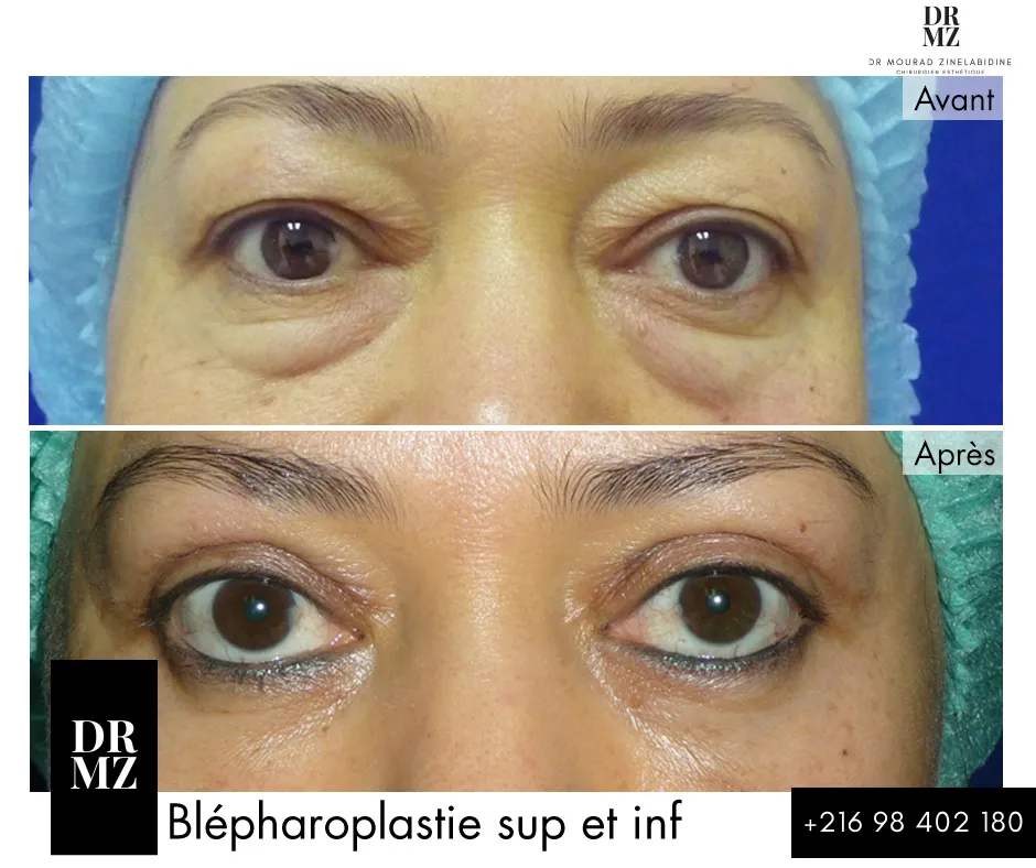 Photo avant & après blépharoplastie Tunisie