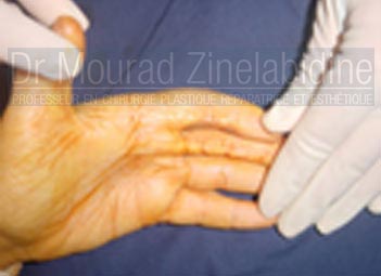 Chirurgie brulés en Tunisie