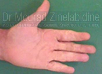 Chirurgie brulés en Tunisie