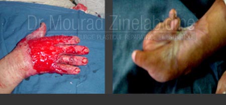 Chirurgie brulés en Tunisie