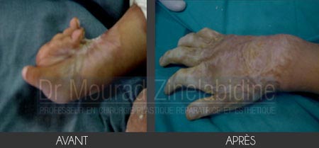 Chirurgie brulés en Tunisie