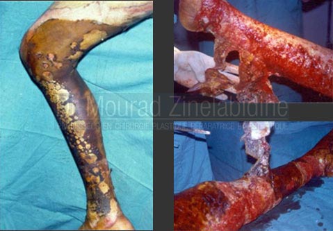 Chirurgie brulés en Tunisie