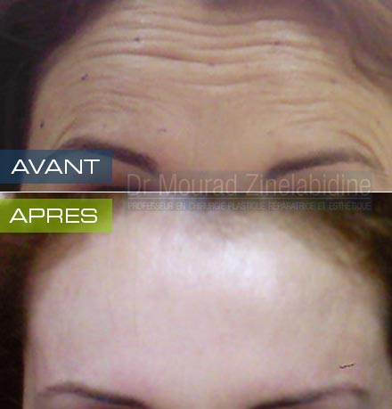 Photo avant & après botox