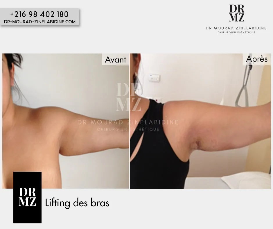 Photo avant & après lifting bras Tunisie