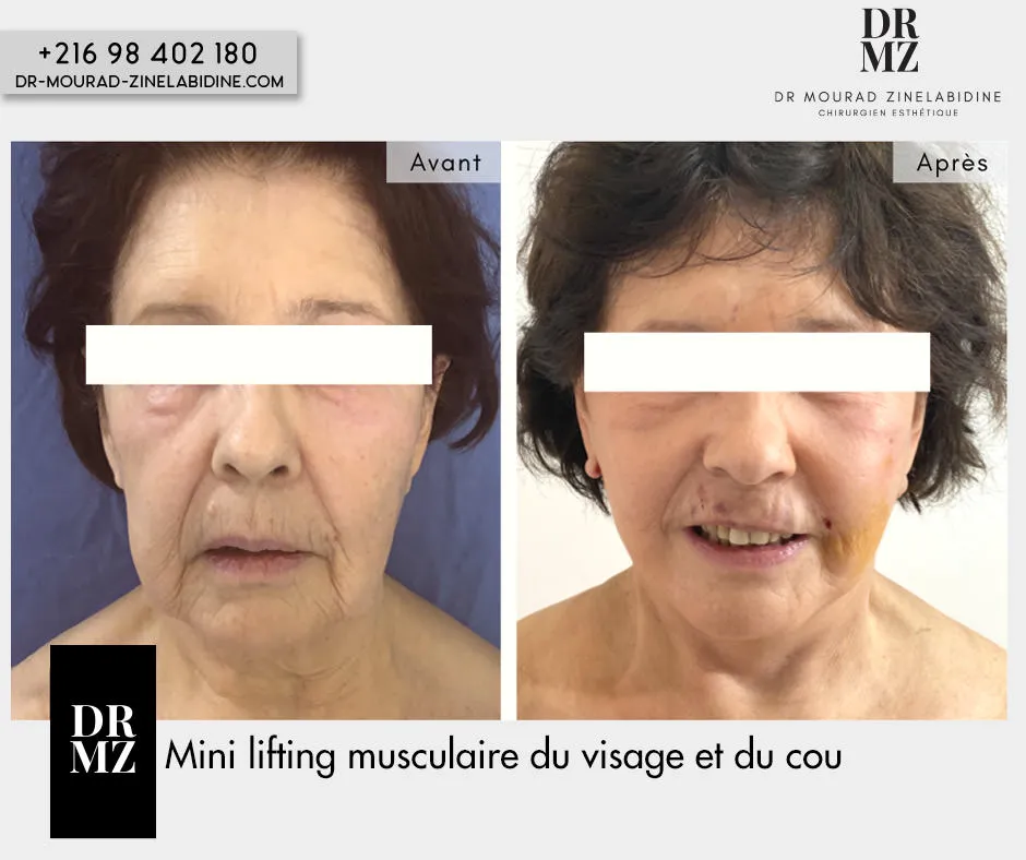 Photo avant & après lifting du visage