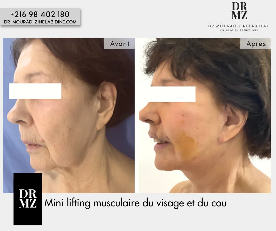Photo avant & après lifting du visage