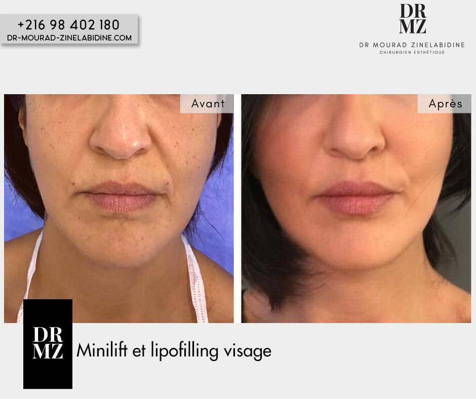 Lifting visage Tunisie